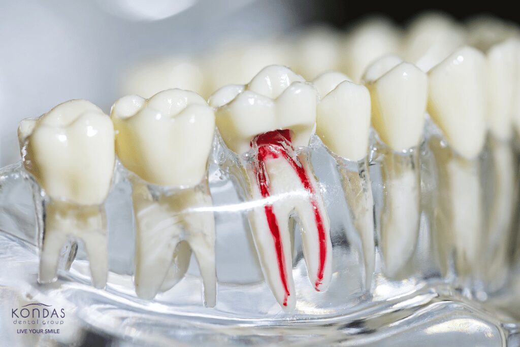 Dental model displaying tooth with root canal procedure