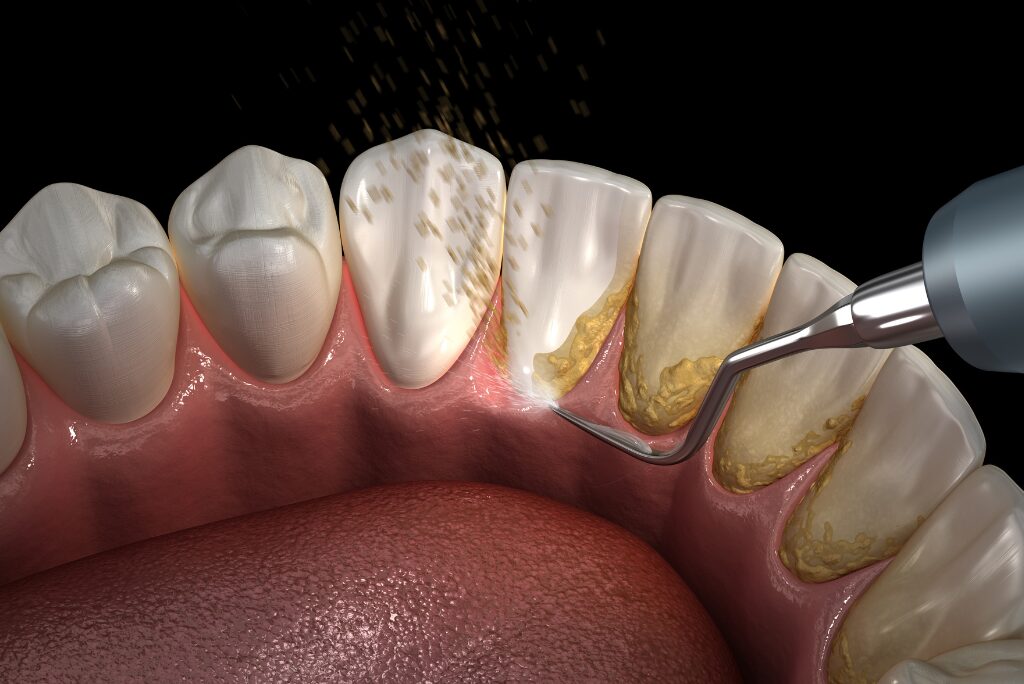 Hard plaque buildup on teeth along the gumline being removed during a dental cleaning procedure.