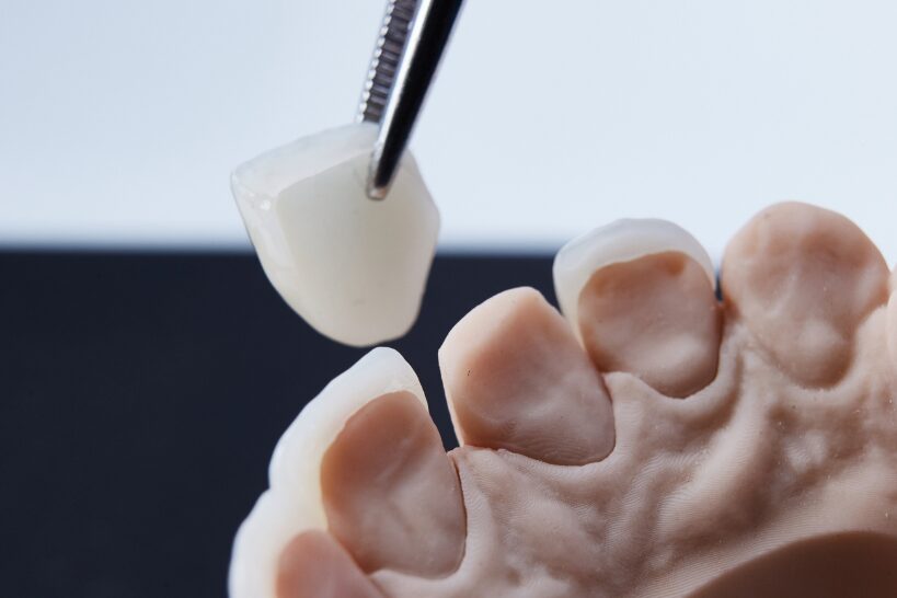 Close-up of a dental crown held with tweezers above a dental model, illustrating crown fit and cosmetic restoration work.